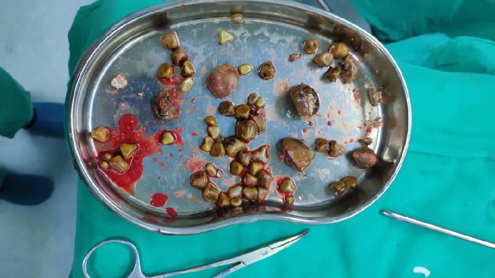 结石病中圣手 还我健康胆囊