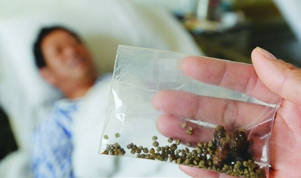 南通文峰中西医结合医院科普：喝奶茶会导致肾结石吗？